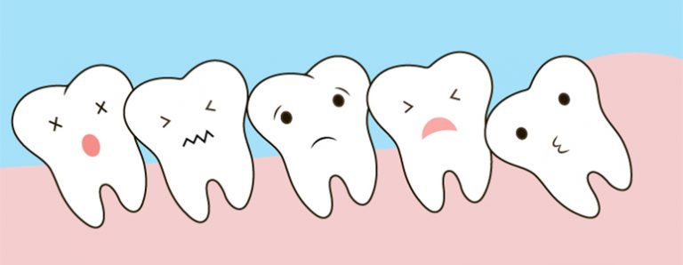 wisdom teeth marbella | muelas del juicio