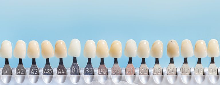 Dental Veneers in Marbella